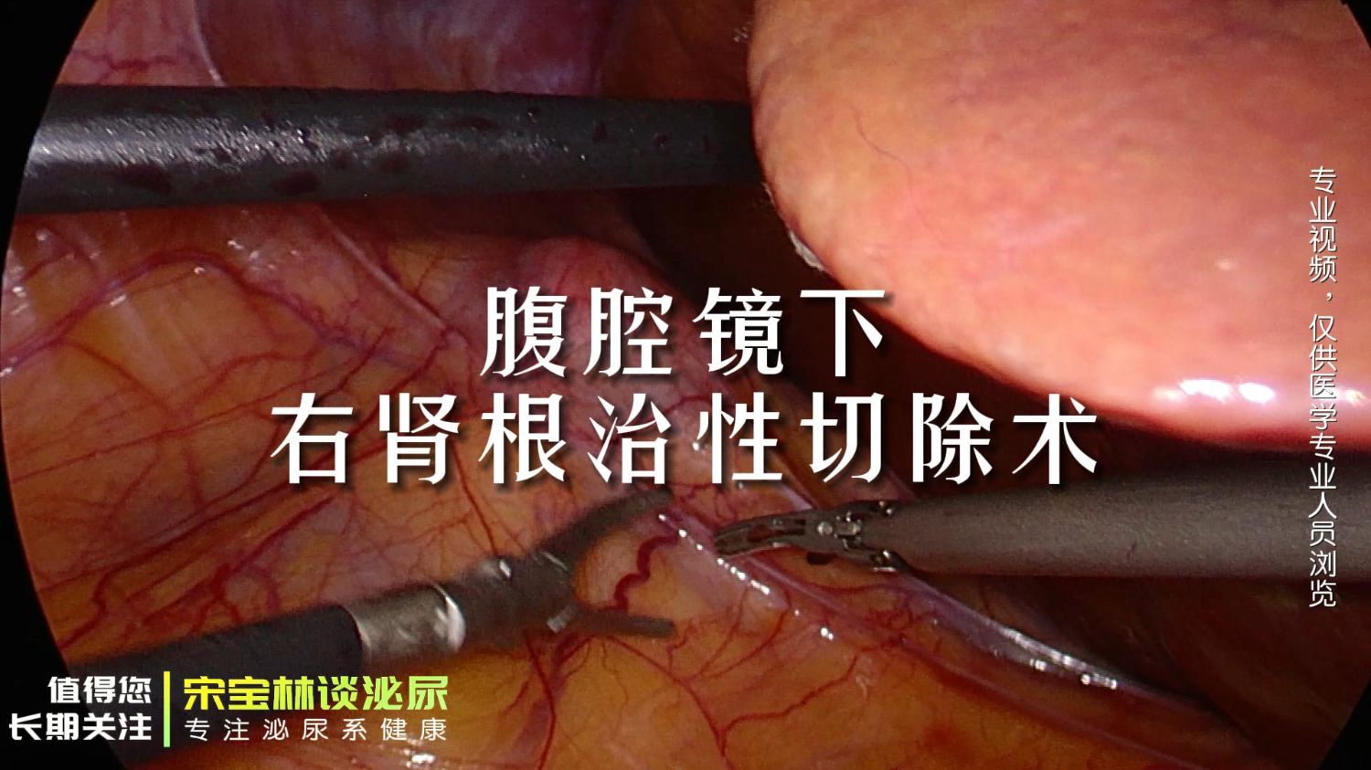 076腹腔镜下右肾根治性切除术-封面.jpg