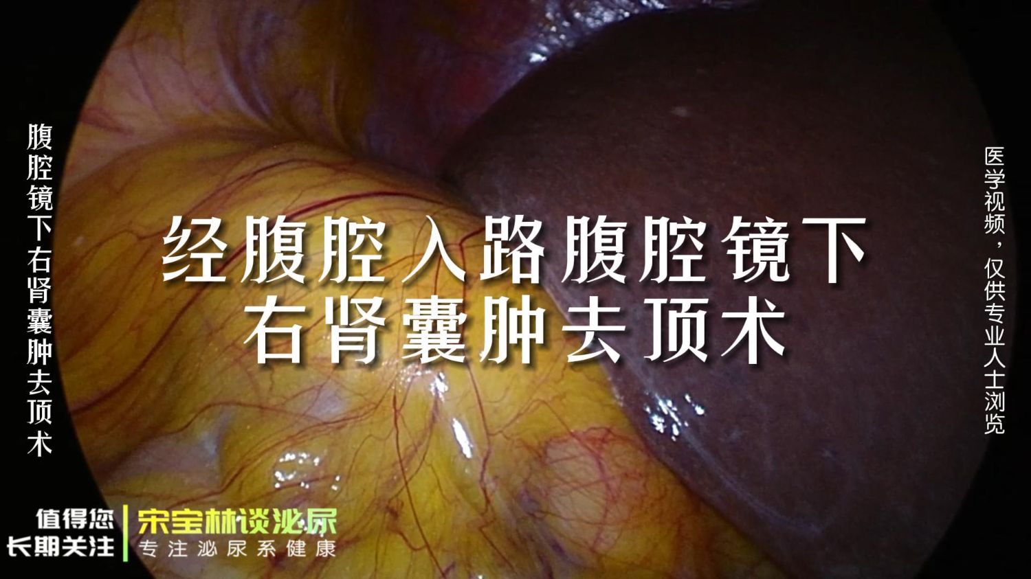079经腹腔入路腹腔镜右肾囊肿去顶术-封面.jpg