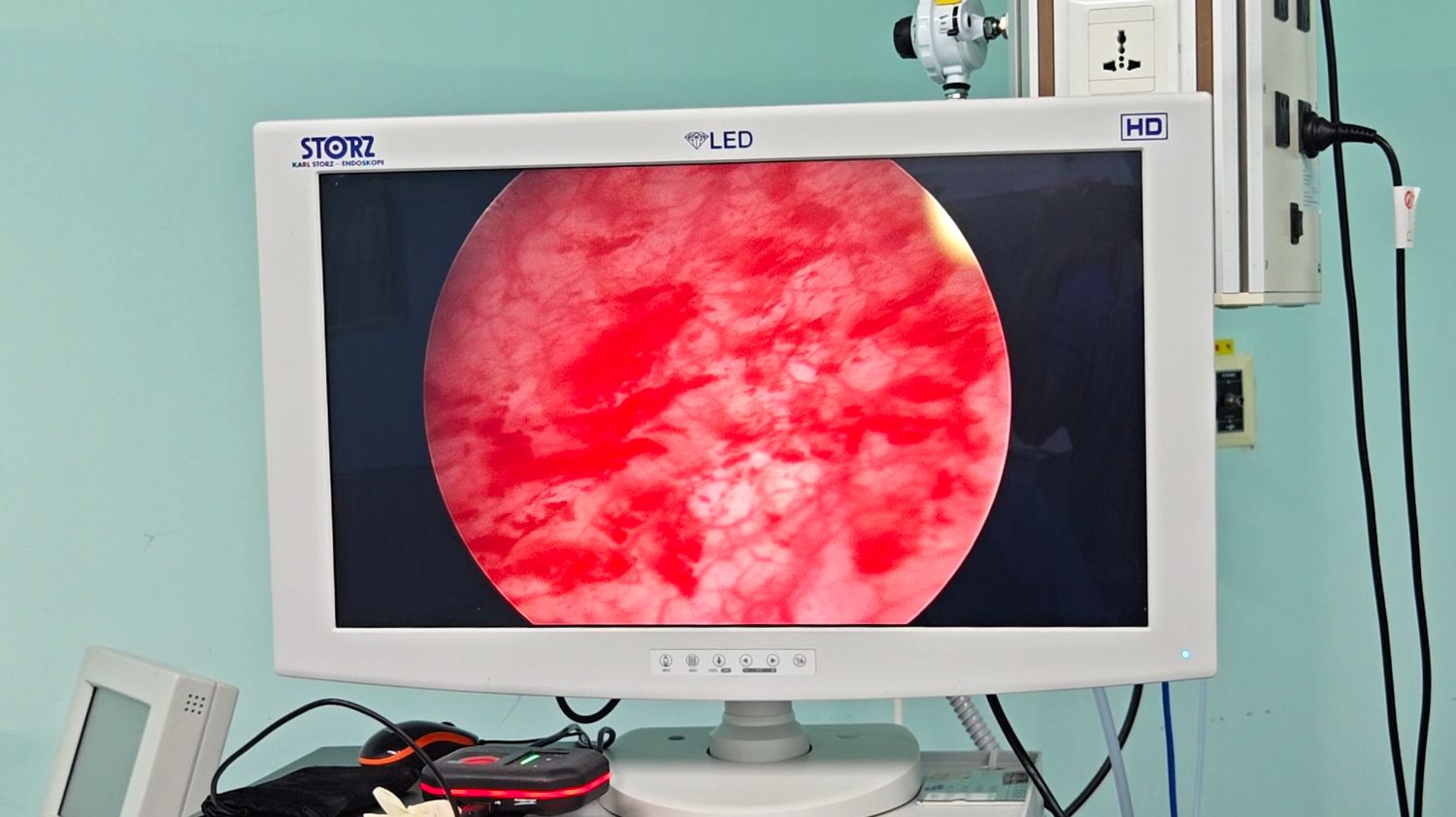 间质性膀胱炎点状出血